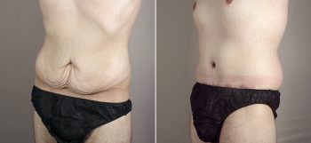 Male Abdominoplasty Patient 8