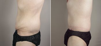 Male Abdominoplasty Patient 8