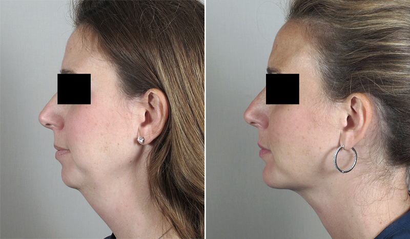 Neck Liposuction & Chin Implant Patient 12