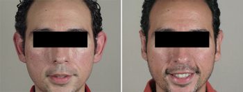 Otoplasty Patient 8
