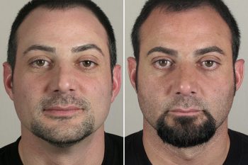 Male Rhinoplasty Patient 14