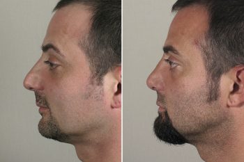 Male Rhinoplasty Patient 14