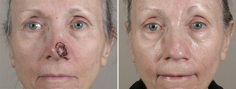 Skin Cancer Treatment Patient 38