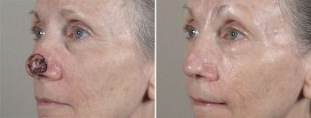 Skin Cancer Treatment Patient 38