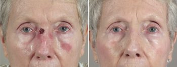 Skin Cancer Treatment Patient 34