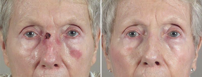 Skin Cancer Treatment Patient 34