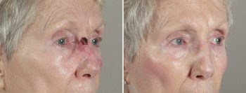 Skin Cancer Treatment Patient 34