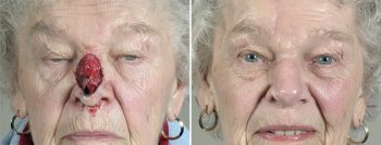 Skin Cancer Treatment Patient 37