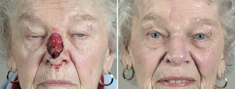 Skin Cancer Treatment Patient 37