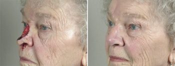 Skin Cancer Treatment Patient 37