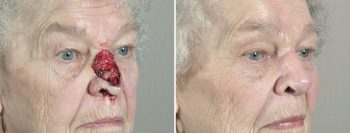 Skin Cancer Treatment Patient 37