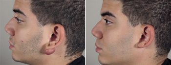 Skin Cancer Treatment Patient 35