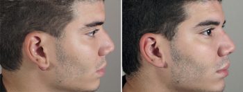 Skin Cancer Treatment Patient 35