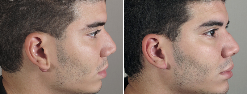 Skin Cancer Treatment Patient 35