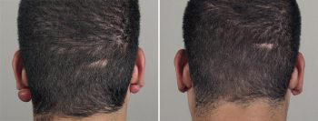 Skin Cancer Treatment Patient 35