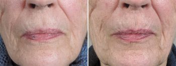 Skin Cancer Treatment Patient 36