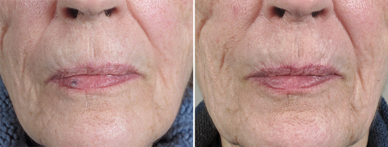 Skin Cancer Treatment Patient 36