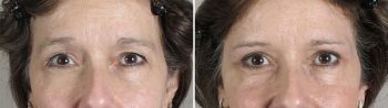 Upper Eyelid Lift Patient 17
