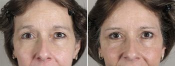 Upper Eyelid Lift Patient 17