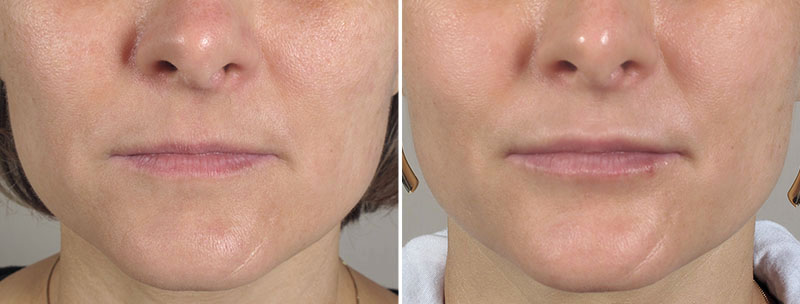 Lip Enhancement Patient 8