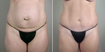 Breast Enlargement (Augmentation) Patient 58