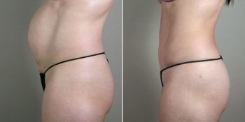 Breast Enlargement (Augmentation) Patient 58