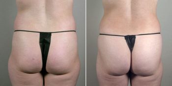 Breast Enlargement (Augmentation) Patient 58