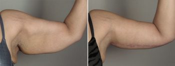 Upper Arm Rejuvenation Patient 11 – Arm Lift