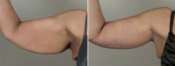Upper Arm Rejuvenation Patient 11 – Arm Lift