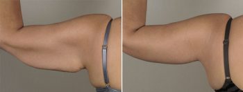 Upper Arm Rejuvenation Patient 11 – Arm Lift