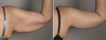 Upper Arm Rejuvenation Patient 11 – Arm Lift