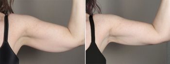 Upper Arm Rejuvenation Patient 12 – Arm Lift