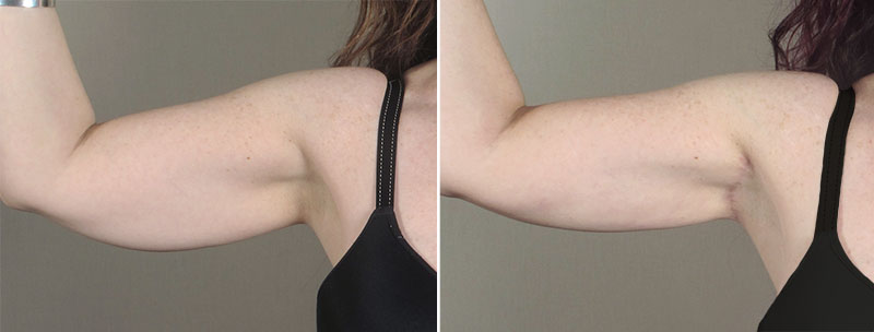 Upper Arm Rejuvenation Patient 12 – Arm Lift