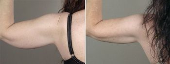 Upper Arm Rejuvenation Patient 12 – Arm Lift
