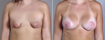 Breast Enlargement (Augmentation) Patient 57