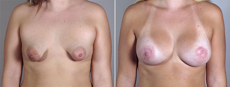 Breast Enlargement (Augmentation) Patient 57