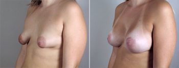 Breast Enlargement (Augmentation) Patient 57