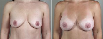 Breast Enlargement (Augmentation) Patient 58