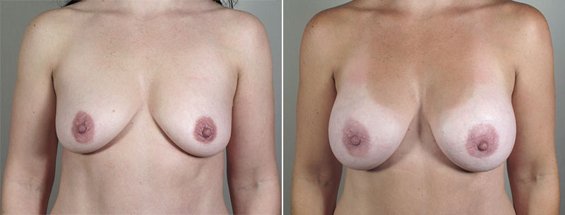 Breast Enlargement (Augmentation) Patient 58