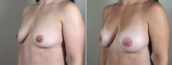 Breast Enlargement (Augmentation) Patient 58