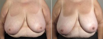 Inverted Nipple Correction Patient 10