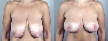 Breast Lift (Vertical Mastopexy Only) Patient 12