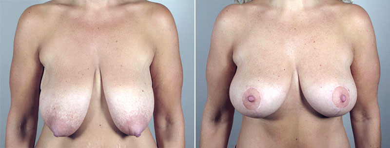 Breast Lift (Vertical Mastopexy Only) Patient 12