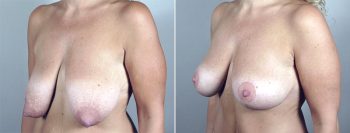 Breast Lift (Vertical Mastopexy Only) Patient 12