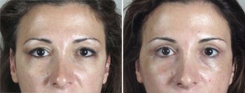 Face Lift Patient 23