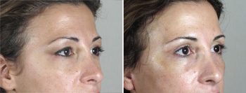 Face Lift Patient 23