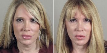 Face Lift Patient 22