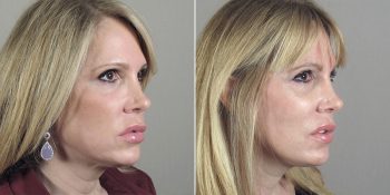 Face Lift Patient 22