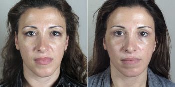 Face Lift Patient 23