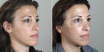Face Lift Patient 23